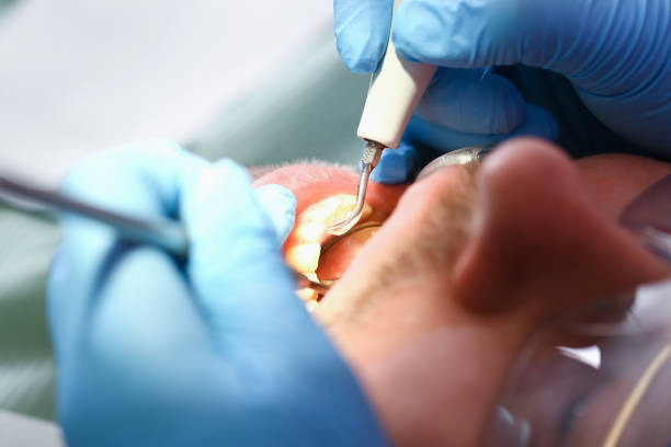 Best Emergency Wisdom Teeth Removal in Morristown, NJ