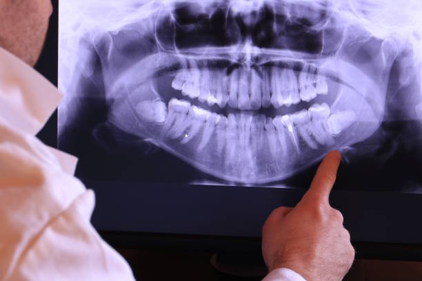 Best Emergency Treatment for Dental Infections or Abscesses in Morristown, NJ